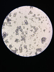 Microscopic view of struvite crystals from urinary sediment. Magnesium ammonium phospate crystals....