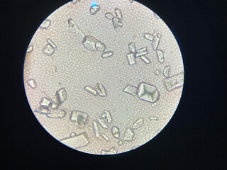 Microscopic view of struvite crystals from urinary sediment. Magnesium ammonium phospate crystals....