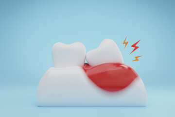 Gums and teeth disease wisdom tooth infection on blue background. 3D rendering. - obrazy, fototapety, plakaty