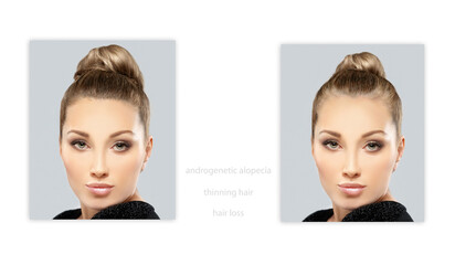 Alopecia Areata,female pattern baldness,Treatment for hair loss,Hair transplant,Surgery to implant...