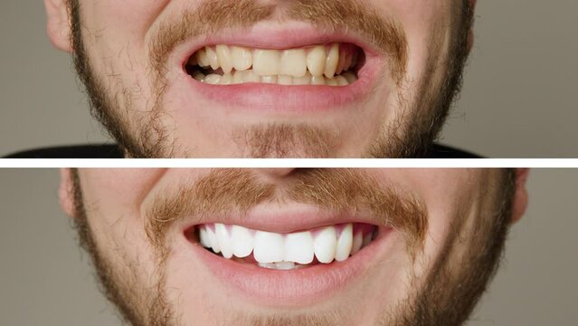 Collage of two superimposed pictures without background, before and after, without writing with a man's teeth. Teeth whitening treatment. Man smiling broadly after teeth whitening procedure