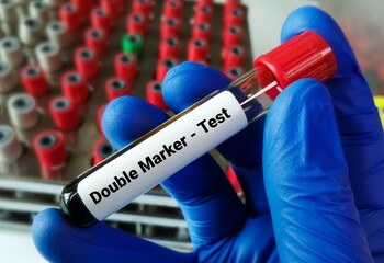 Blood sample for Double Marker Test. Pregnancy marker.
