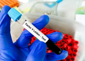 Blood sample for Factor V Leiden test, a mutation of clotting factors in the blood which may...