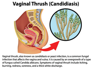 Vaginal Thrush (Candidiasis) infographic with explanation