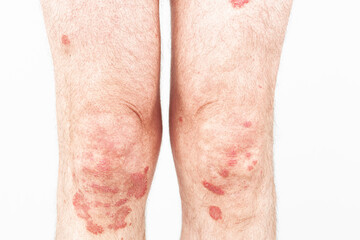 Eczema on legs.  Allergy spots and red  skin inflammation on  feet. Close-up of the legs of a man...