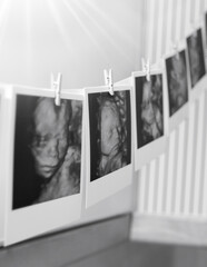 Collage of black and white photos story of ultrasound pictures of baby. Family, Childbirth, New...