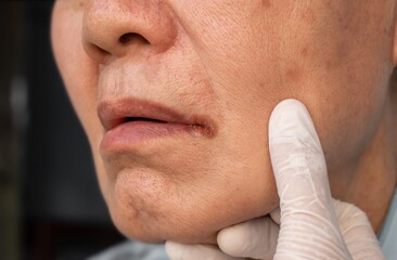 Angular stomatitis or angular cheilitis or perleche in asian elder man. Mouth ulcer. Common...