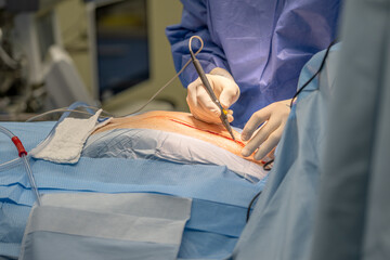 A chief physician in cardiac surgery opens the chest with an electronic scalpel in order to be able...