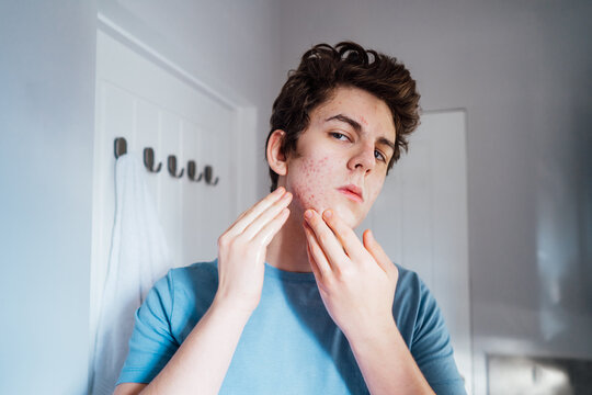 Concentrated caucasian teenage boy with acne problem at his face looking in mirror at home bathroom. Teenager skin care every day treatment process.