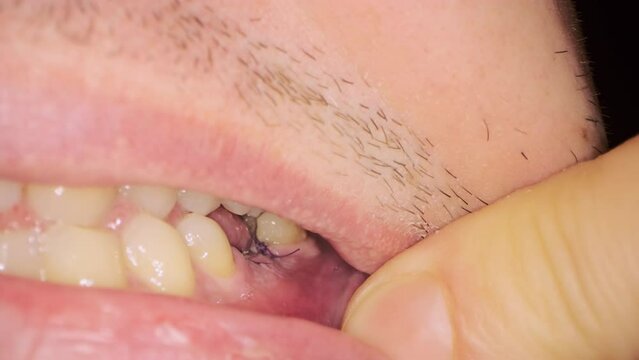 Man opens mouth with finger showing black threads on gum after implant placement. Professional teeth treatment in dental clinic extreme closeup