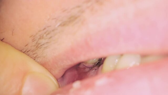 Oral cavity of male patient after tooth implantation in modern dental clinic. Man opens mouth to show black threads on gum extreme closeup