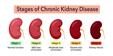 Stages of chronic kidney disease infographic concept vector illustration on white background. - obrazy, fototapety, plakaty