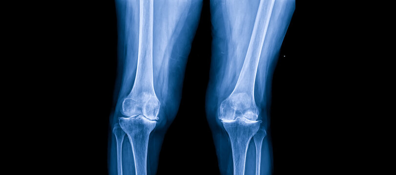 Plain radiograph on dark background in hospital.The xray use for diagnosis of the illness of patient.Medical concept.Osteoarthritis of knee in elderly woman.The blue tone of xray shows joint narrowing