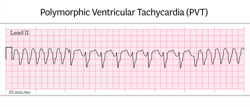 Polymorphic Ventricular Tachycardia (PVT) ECG &ndash; Polymorphic VT - 8 Second ECG Paper - Vector Medical Illustration