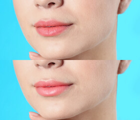 Obraz premium Collage with photos of woman before and after using lip balm on light blue background, closeup