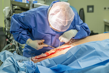A doctor of heart surgery uncovers a vein on a leg to harvest it for heart bypass.Health and heart surgery concept