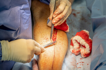 A heart surgeon sews up a leg from which a vein was previously removed for a heart bypass. Concept: health and cardiac surgery
