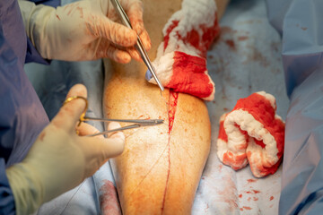 A heart surgeon sews up a leg from which a vein was previously removed for a heart bypass. Concept:...
