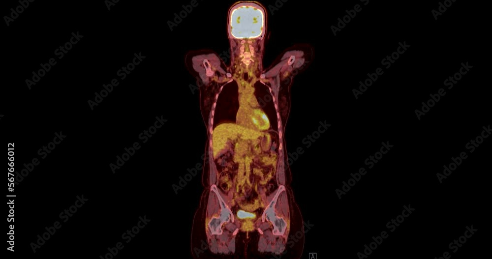 Poster pet ct scan ( positron emission tomography ) of whole human body 3d rendering image red color tone a