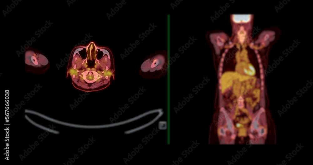 Poster pet ct scan ( positron emission tomography ) of whole human body 3d rendering image red color tone a