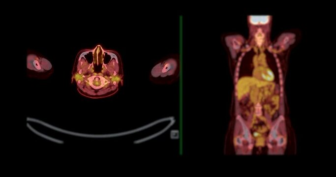  PET CT SCAN ( Positron Emission Tomography )  of whole human body 3d rendering image red color tone axial view for detect tumor recurrence after surgery.