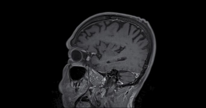 MRI Brain sagittal view with gadolinium can help doctors look for conditions such as bleeding, swelling, tumors, infections, inflammation, damage from an injury or a stroke diseases.
