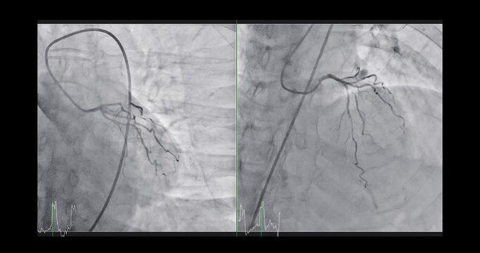 Cardiac catheterization showing coronary arteries for diagnosis cardiac arrest .