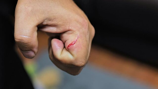 Deep scratches, cut on a man hand skin. Fresh wound, abrasions. Injured hand with blood. Close up