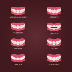 Human teeth malocclusion set with realistic images of mouth jaws with crooked teeth and text captions. Normal and abnormal occlusion. Vector illustration