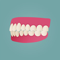 Human teeth malocclusion set with realistic images of mouth jaws with crooked teeth and text captions. Normal and abnormal occlusion. Vector illustration