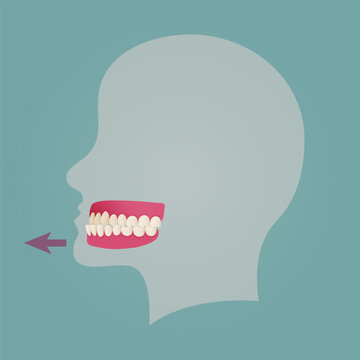 Human teeth malocclusion set with realistic images of mouth jaws with crooked teeth and text captions. Normal and abnormal occlusion. Vector illustration