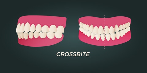 Medical dental diagram illustration. Orthodontist human tooth anatomy. Vector infographics with teeth diagrams.
