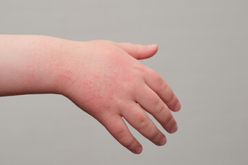 The child scratches atopic skin. Dermatitis, diathesis, allergy on the child's body.irritation and...