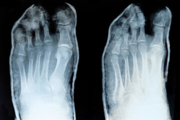 x-ray of toes, with displaced little finger