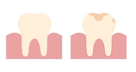 Healthy tooth and decayed tooth. Vector illustration