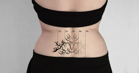 Rear View Of Laser Tattoo Removal