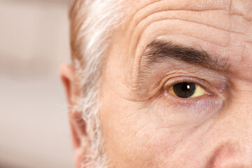 Senior man with yellow eyes on blurred background, closeup. Symptom of hepatitis