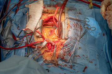 A heart surgeon has opened a chest. Everything has been prepared here so that a bypass can be laid....