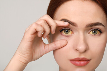 Woman with yellow eyes on light grey background. Symptom of hepatitis