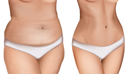 Vector illustration of fat and slim female body. Cellulite body problem. Before and after weight loss.