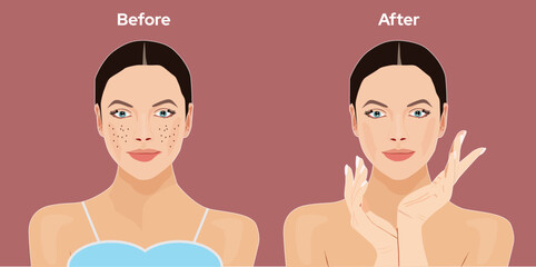 Acne scar before and after illustration. A beautiful face without acne and looks younger. Dull skin, rejuvenate your skin vector, skin care banner image, dermatology banner design