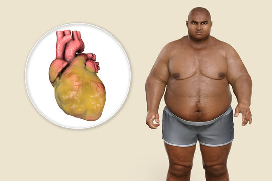 Obese Heart In Overweight Man, 3D Illustration. Concept Of Obesity And Inner Organs Disease