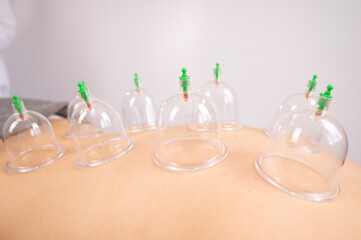 Female massage therapist uses vacuum cans on the patient's back. 