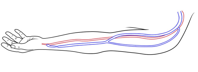 radiocephalic arteriovenous fistula stenosis at the anastomosis
