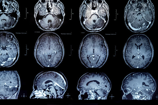 mri with brain tumor. Magnetic resonance imaging.