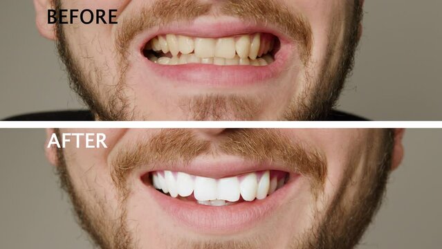 Collage of two superimposed pictures without background before and after with black and white writing with a man's teeth. Teeth whitening treatment. Man smiling broadly after teeth whitening procedure