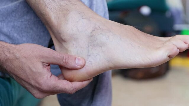 Blisters on the foot of a Caucasian man sitting on the couch