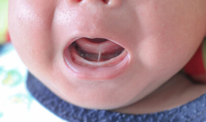 Tongue-tie patient , baby health problem , baby show tongue and gum