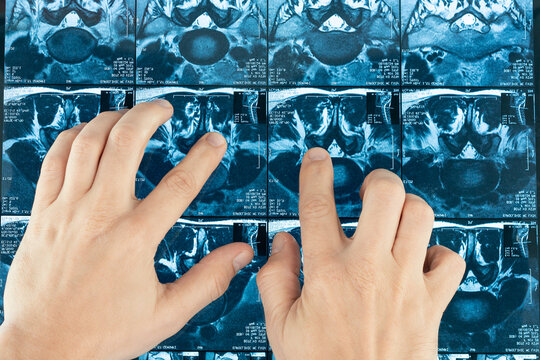 The doctor analyzes the X-ray of the hip joint and pelvic bones.