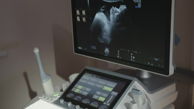 The doctor's hand controls the ultrasound device. A 4D or 3D ultrasound of a 39 week gestational baby on a fetal ultrasound showing detail of her face. A pregnant woman undergoes a 4D ultrasound.